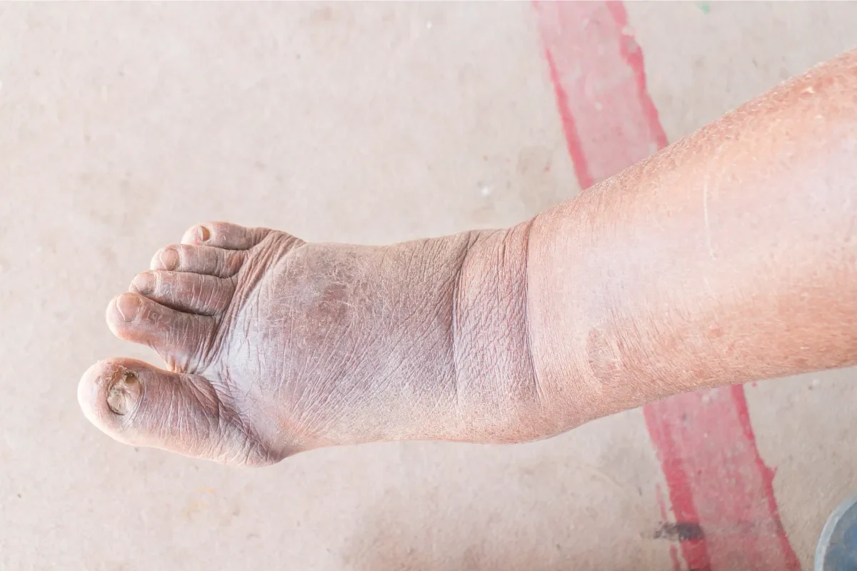 Algodystrophie phase froide : meilleurs traitements efficaces